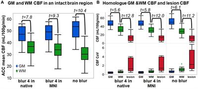 ASL MRI informs blood flow to chronic stroke lesions in patients with aphasia